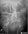 Toxic Megacolon